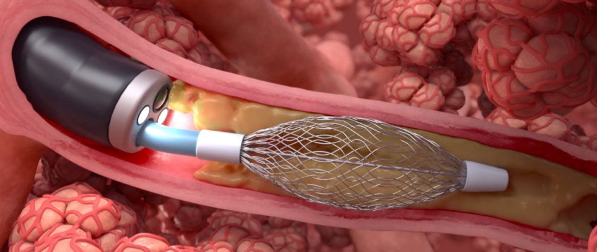 Illustration-Bronchial Rheoplasty Procedure using the RheOx System